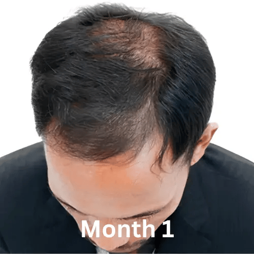 Hair Regrowth Oil + Hair Regrowth Shampoo (Free)